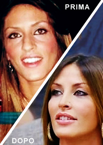 Guendalina Tavassi: prima e dopo la rinoplastica. Foto