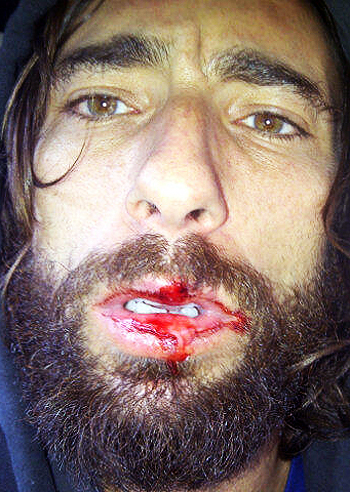 Incidente in bici per Vittorio Brumotti