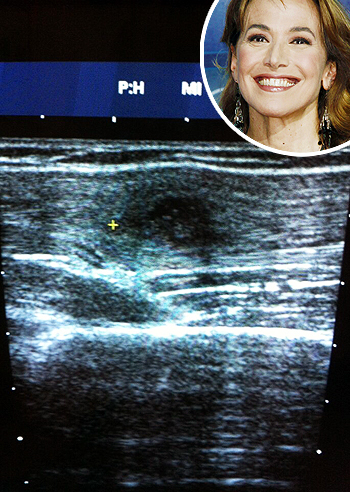 Lesione al bicipite destro per Barbara