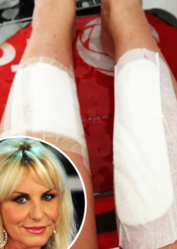 Antonella Clerici, botta sugli stinchi