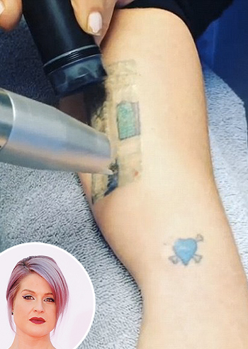 Kelly Osbourne rimuove i tattoo