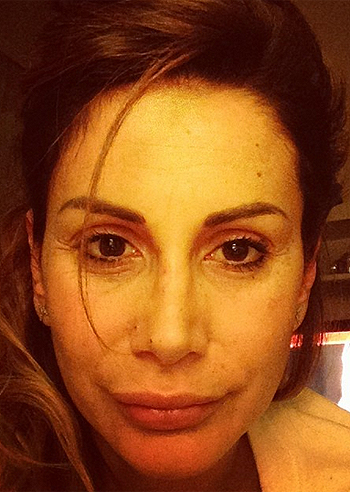 Simona Salvemini e l'abuso di botox