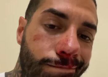 Francesco Chiofalo, nuova operazione: le sconvolgenti immagini del viso tumefatto e insanguinato