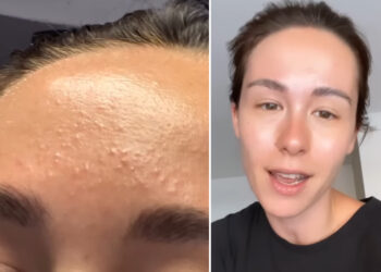 Aurora Ramazzotti 'allergica al sole': la reazione della pelle