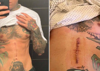 Fedez mostra la cicatrice tre mesi dopo l'operazione per rimuovere il cancro: 