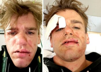 Faccia tumefatta e tanta paura: un famoso comico tv ridotto male dopo la rapina