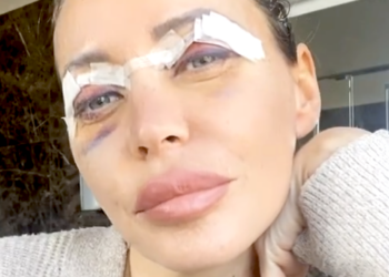 ''Non accettavo le palpebre da pesce lesso'': Karina Cascella mostra gli occhi dopo la blefaroplastica