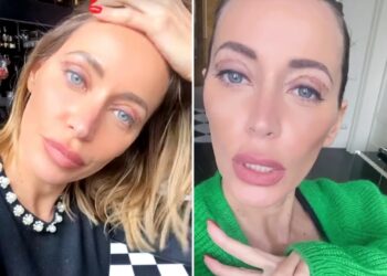 Karina Cascella mostra il risultato della blefaro a 10 giorni dall'intervento: ''Un capolavoro, occhi sempre più aperti''