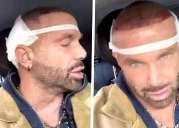 ''Dolori insopportabili e 10 ore di intervento'': Alex Nuccetelli si è operato per avere capelli più folti