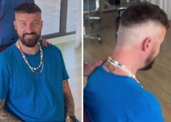 Francesco Facchinetti si sottopone all'infoltimento dei capelli