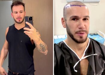 Matteo Diamante, ex Isola dei Famosi e GF, ha fatto il trapianto di capelli: le immagini post operatorie
