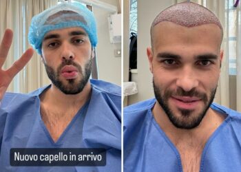 Goffredo Cerza, compagno di Aurora Ramazzotti, si è sottoposto a un trapianto di capelli e mostra tutto sul social: foto