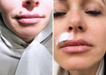 ''L’ho fatto'': Sonia Bruganelli si è sottoposta a un altro intervento di chirurgia estetica, le foto