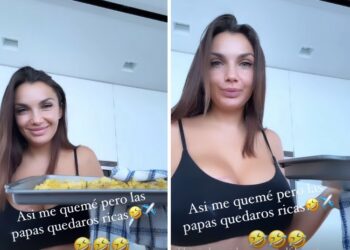 Elettra Lamborghini si è ustionata un seno!