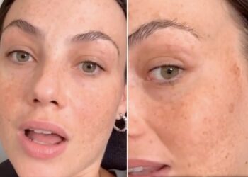 Rosalinda Cannavò mostra le macchie dovute alla gravidanza