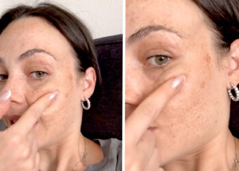 ''Queste macchie sono dovute alla gravidanza, non andranno via'': Rosalinda Cannavò mostra i segni della gestazione sul viso