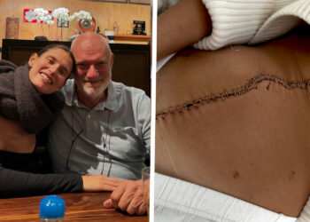 Bianca Balti mostra l'enorme cicatrice sulla pancia dopo l'intervento per rimuovere il tumore e si fa vedere sempre ottimista