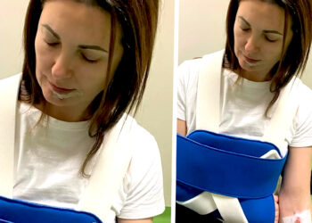 Sub-lussazione della spalla e tre punti di sutura sul viso dopo la corsa in ospedale: Giovanna Civitillo rivela cosa le è successo