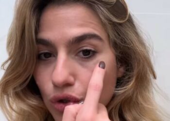 Cristina Marino mostra l’occhio nero dopo un incidente sul lavoro