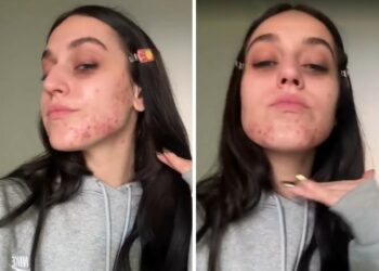 ''La mia pelle urla e chiede aiuto'': la cantante Gaia mostra lo sfogo cutaneo sul viso a causa del periodo che sta vivendo, guarda