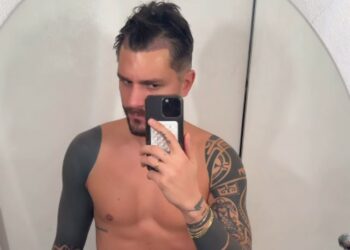 Andrea Zelletta ha fatto il trapianto di capelli