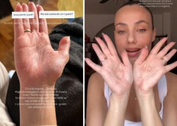 Rosalinda Cannavò mostra le mani sofferenti e svela il problema di salute che la obbliga a indossare guanti