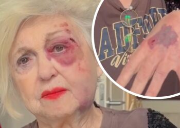 Ecchimosi e graffi: Wanna Marchi si mostra sul social ''devastata'', ecco cos’è successo