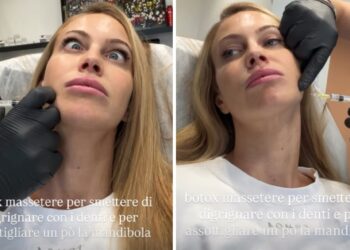''18.30 vengo a farmi il Botox'': Taylor Mega va da chirurgo estetico per un ritocchino salvifico, ecco quale