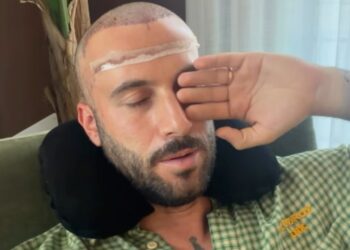 Andreas Muller mostra il post trapianto di capelli: guarda